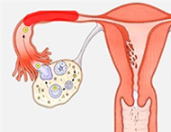 女性：输卵管障碍